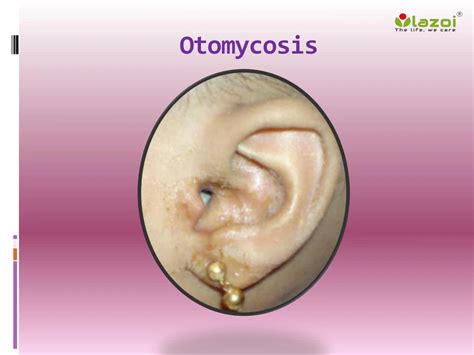 PPT - Otomycosis: Causes, Symptoms, Daignosis, Prevention and Treatment ...