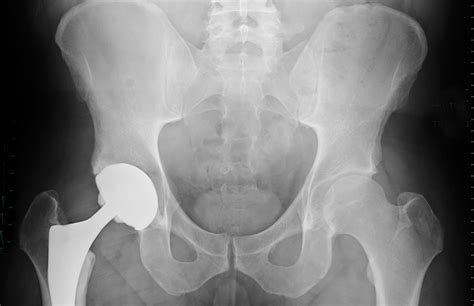 Rates of Knee, Hip Arthroplasty Increasing Among Patients With ...