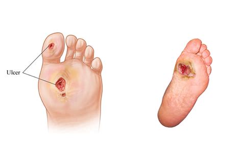 Diabetic Ulcers - Country Foot Care