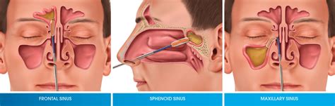 Balloon Sinuplasty Basics, Treatment Cost, Recovery and Side Effects