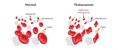 5 Common Thalassaemia Questions | CFCH | Singapore