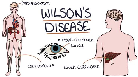 Understanding Wilson's Disease - YouTube