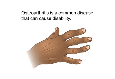 PatEdu.com : Osteoarthritis