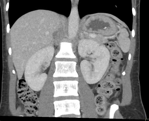 Right Adrenal Adenoma / CTisus.com | Adrenals, Case study, Study