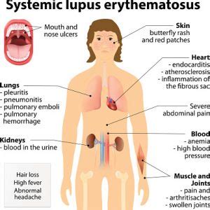 Lupus vs. rosacea, differences in symptoms, causes, and treatment