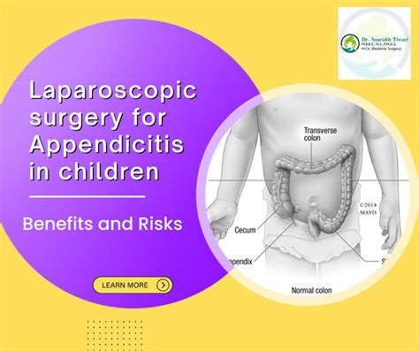 Laparoscopic surgery for Appendicitis in children | Benefits & Risks