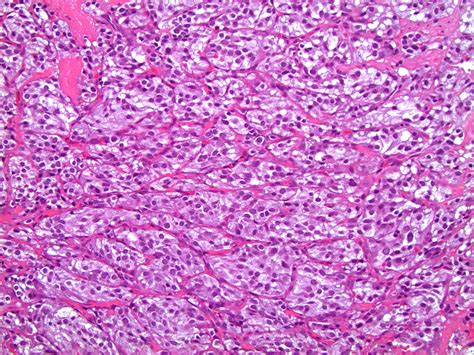 Pathology Outlines - Paraganglioma