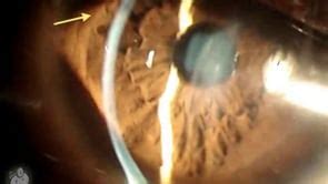 Rizzuti's corneal light reflex seen in keratoconus (Video) - TimRoot.com