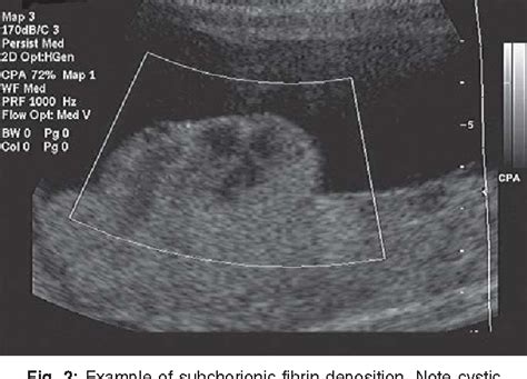 Ultrasound of the Placenta | Semantic Scholar