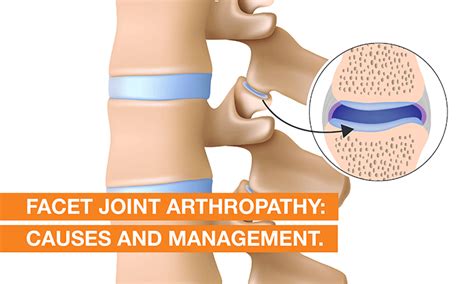 Facet Joint Arthropathy Treatment, Symptoms & Causes | QI Spine