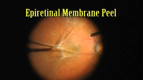 Retinal Membrane Peel: Effective Treatment for Macular Disorders at ...