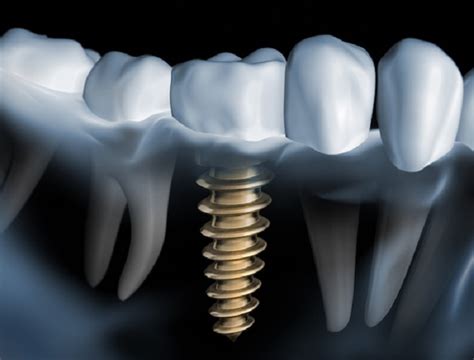 Dental implant 3d - Are 3D dental implants necessary in dental implants?