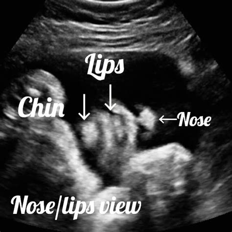 Normal 34 week baby ultrasound. - Ultrasoundfeminsider