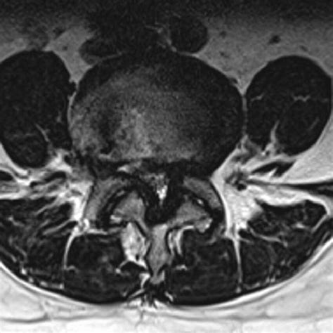 Preoperative picture showing lateral recess stenosis | Download Scientific Diagram