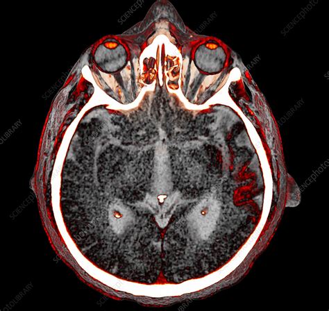 Sturge-Weber syndrome, CT scan - Stock Image - C057/7934 - Science ...