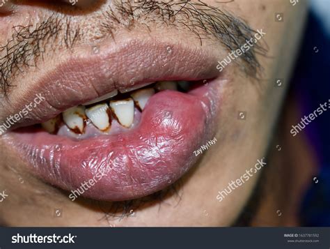 Mucous Cyst Mucocele Lower Lip Southeast: стоковая фотография ...