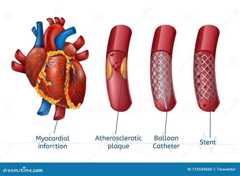 Infarto Del Miocardio Stent De 3d Realostic En Corazón Ilustración del ...