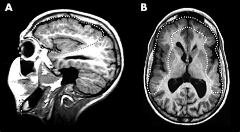 Genetics of the polymicrogyria syndromes | Journal of Medical Genetics