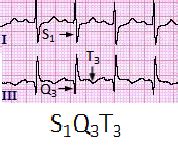 S1Q3T3-ECG-PulmonaryEmbolism