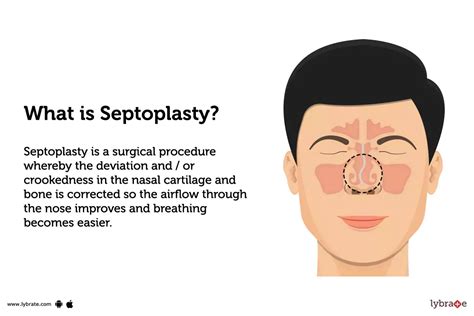 Septoplasty: Treatment, Procedure, Cost, Recovery, Side Effects And More