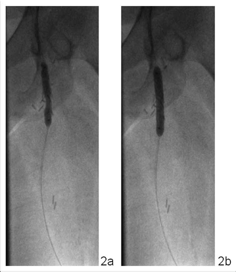 A) Initial filling of balloon tip of the balloon catheter confirming ...