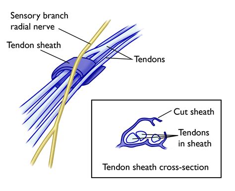 De Quervain's Tenosynovitis Symptoms and Treatment - OrthoInfo - AAOS