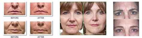 Best Wrinkle Fillers Treatment | Reflections Image Center