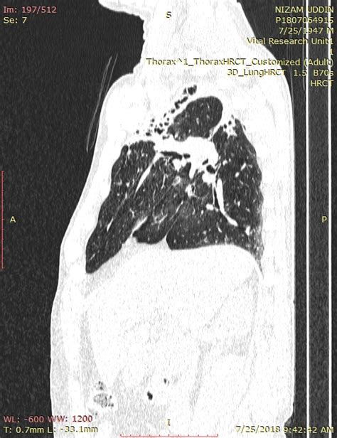 bronchiectasis radiology | apical pleural thickening ct | scattered ...