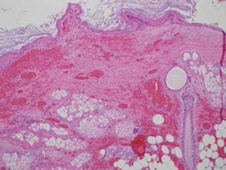 Laparoscopic management of tubo-ovarian torsion and necrosis secondary to dermoid cyst in early ...