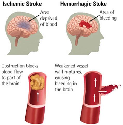 Ischemic Stroke - Causes, Signs, Symptoms & Ischemic Stroke Treatment