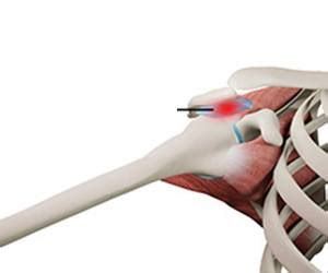 Shoulder Bursitis Treatment Albany NY | Bursectomy Delmar, Clifton Park