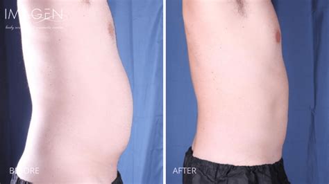 Lipo 360 - Omaha,NE - Omaha Liposuction by Imagen