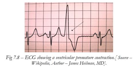 1-11. VENTRICULAR ARRHYTHMIAS: B. PVC’S - Cardiac Rhythm Interpretation