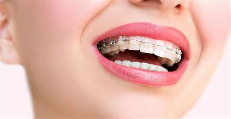 How Long Do Invisalign Vivera Retainers Last? - M. Scott Runnels D.M.D., P.A.