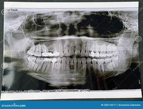 Adult Dental X-ray with Root Treatment, Post, Crown and Not Fully ...