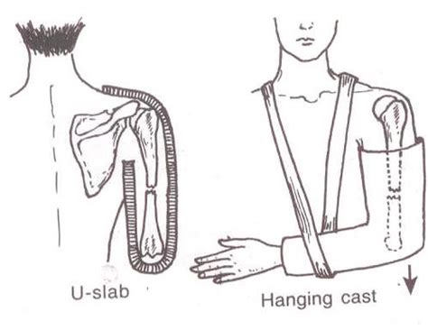 Humerus Shaft Fracture Diagnosis and Treatment | Bone and Spine