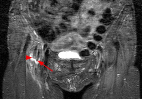 Iliopsoas Tendinopathy | Radsource