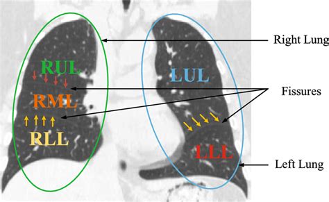 A coronal lung CT slice with visible fissures. Major fissures are ...