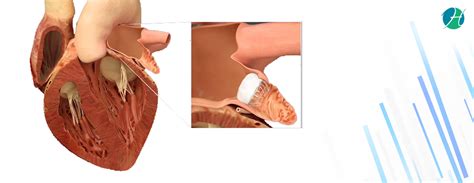 Left Atrial Appendage Closure Device (WATCHMAN device): Indications and Risks | Cardiac ...