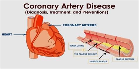 Coronary artery disease (Diagnosis, Treatment, and Preventions) - Assignment Point