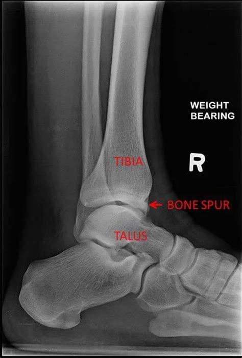 Ankle Bone Spur - Cause, Symptoms, Treatment