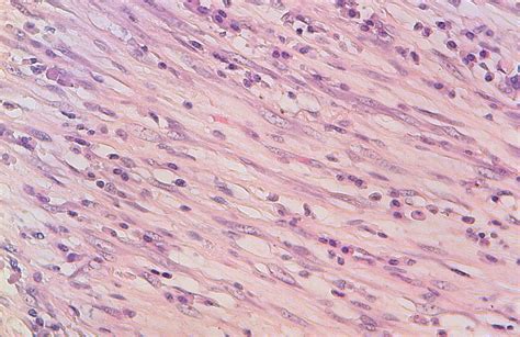 Proliferation of regular myofibroblasts mixed with lymphocytes and... | Download Scientific Diagram