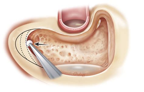 Mastoidectomy | Ento Key