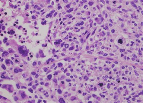 Pathologic findings. The high power view of the metastatic ...