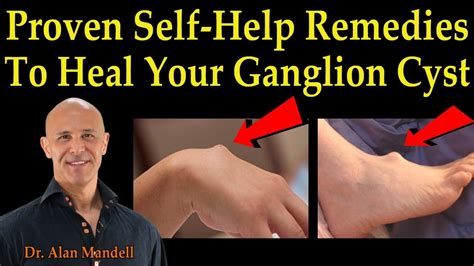 Proven Self-Help Remedies To Heal Your Ganglion Cyst - Dr. Alan Mandell ...