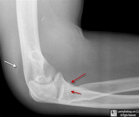 Learning Radiology - Posterior Fat Pad Sign