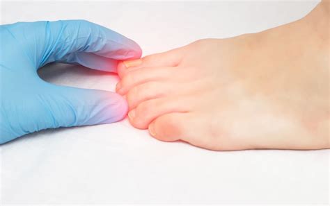 Stubbed Toe Treatment: When Do You Need To Seek Help?