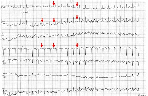 ECG Rhythms: Can you see the P?