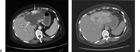 1 Hepatic Hemangioma | Radiology Key