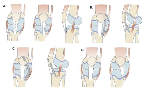 patellofemoral instability treatment